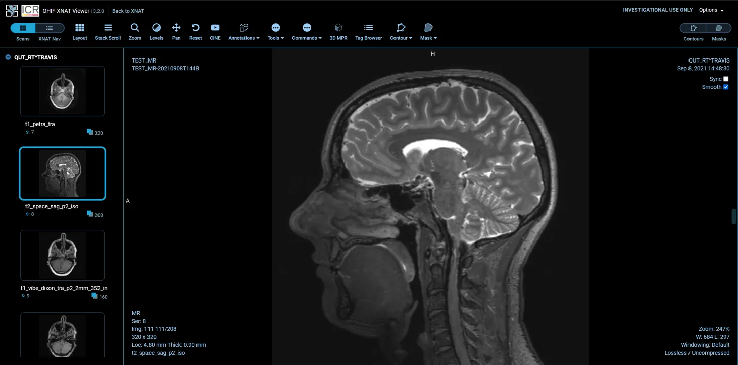 Imaging session open in the OHIF Viewer